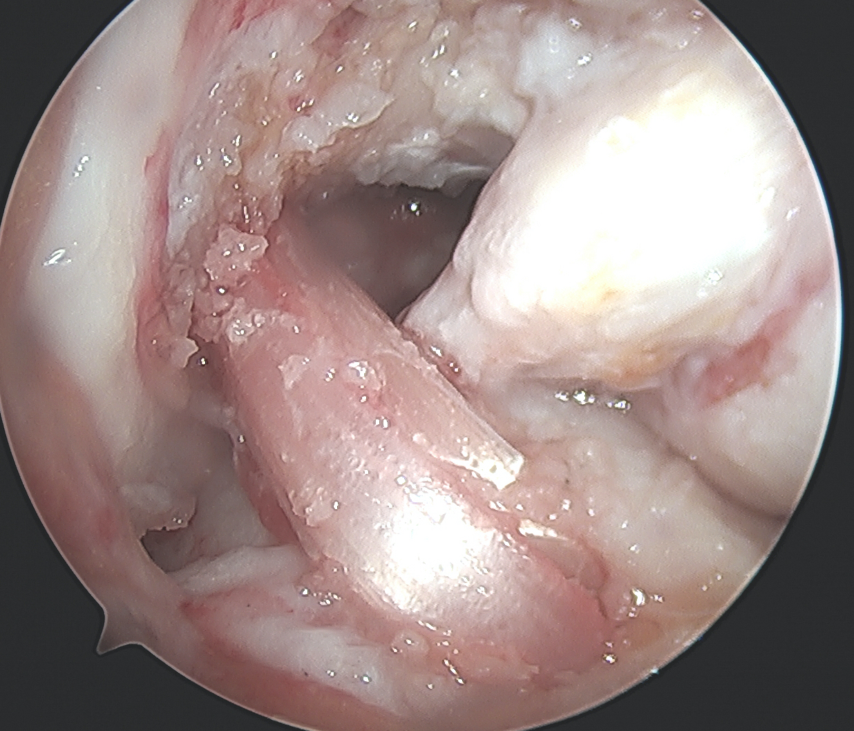 ACL PCL reconstruction